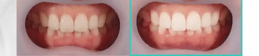 라이브오랄스 퓨어다이아 셀프 치아미백제 (2주분) 상세페이지 15