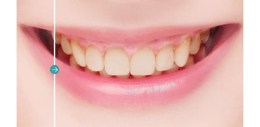 라이브오랄스 퓨어다이아 치아미백제(2주분) 기획 / 단품 상세페이지 4