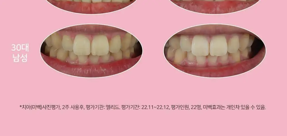 유시몰 화이트닝 미백치약 106g 기획 (+로열 크라운 핑크 스퀴저) (바비 콜라보) 상세페이지 22