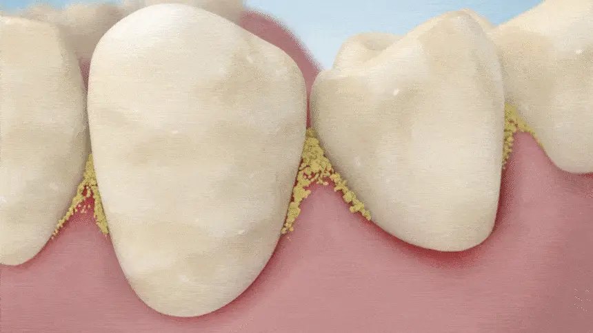 화이니카 치탄플러스 분말치약 20g 상세페이지 18