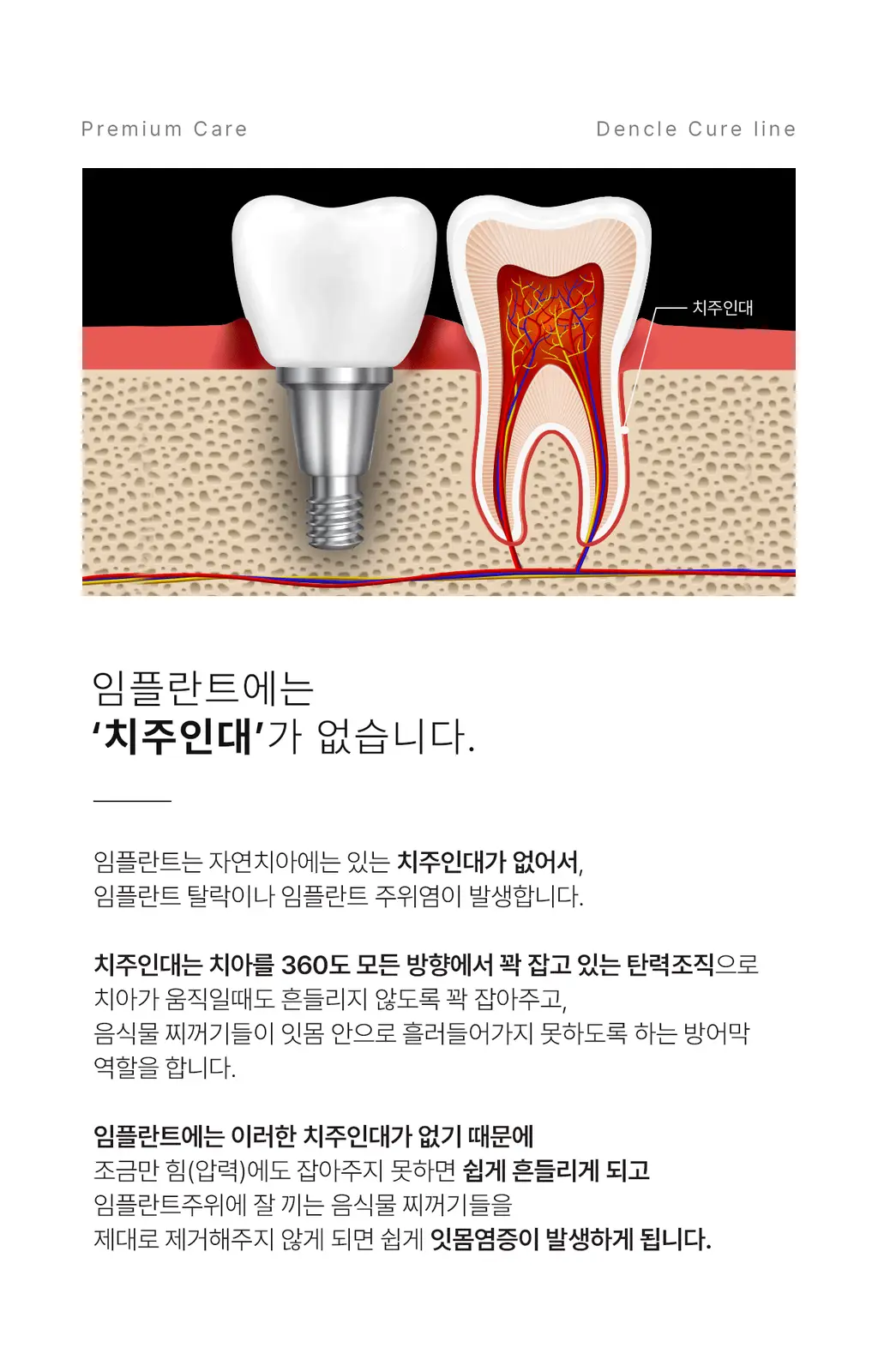 덴클 임플란트케어 칫솔 1개입 상세페이지 7