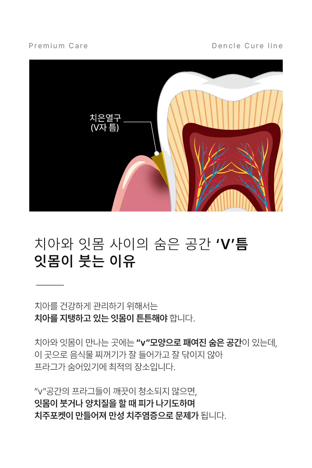 덴클 잇몸케어 칫솔 1개입 상세페이지 2