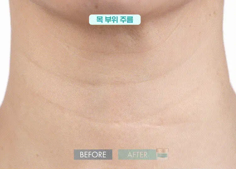 테라비코스 히알루론산 3000 링클 앰플 패드 60매 상세페이지 19