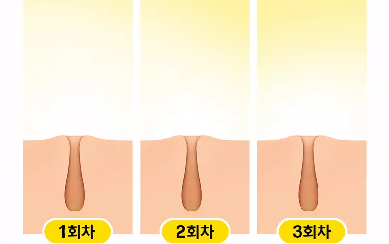 고릴라왁싱 3in1 멀티 모근제거기 바디트리머 2000V 상세페이지 13