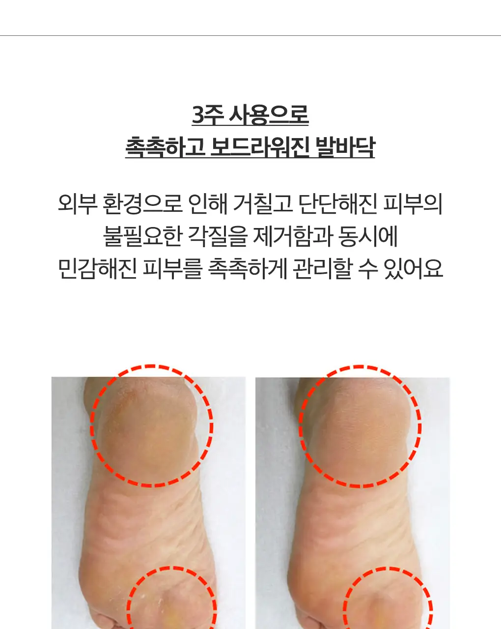 닥터원더 발 각질제거 악어발팩 상세페이지 18