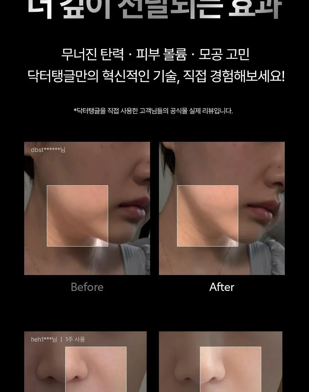 닥터탱글 고주파 마사지기 블랙 에디션 상세페이지 3