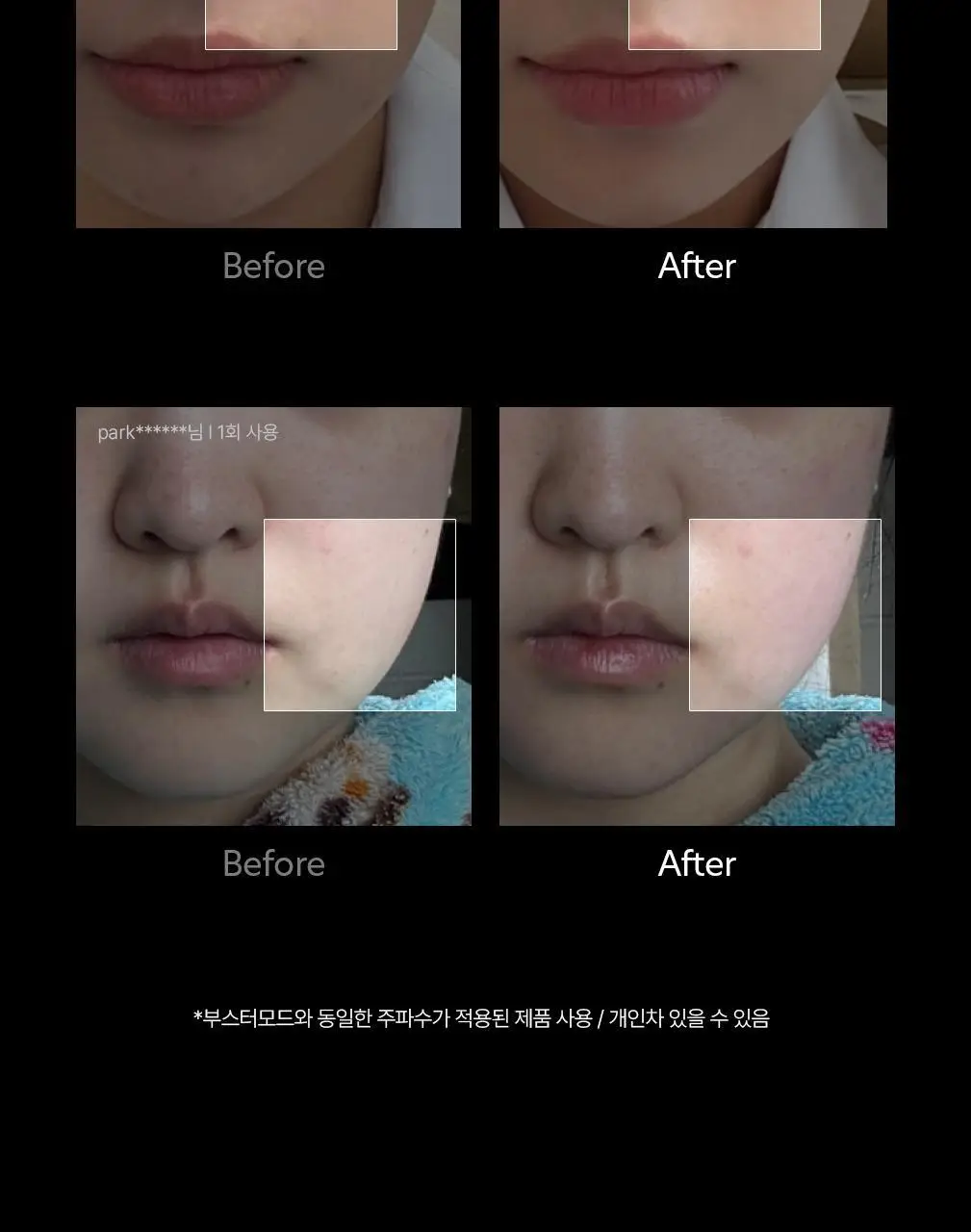 닥터탱글 고주파 마사지기 블랙 에디션 상세페이지 4