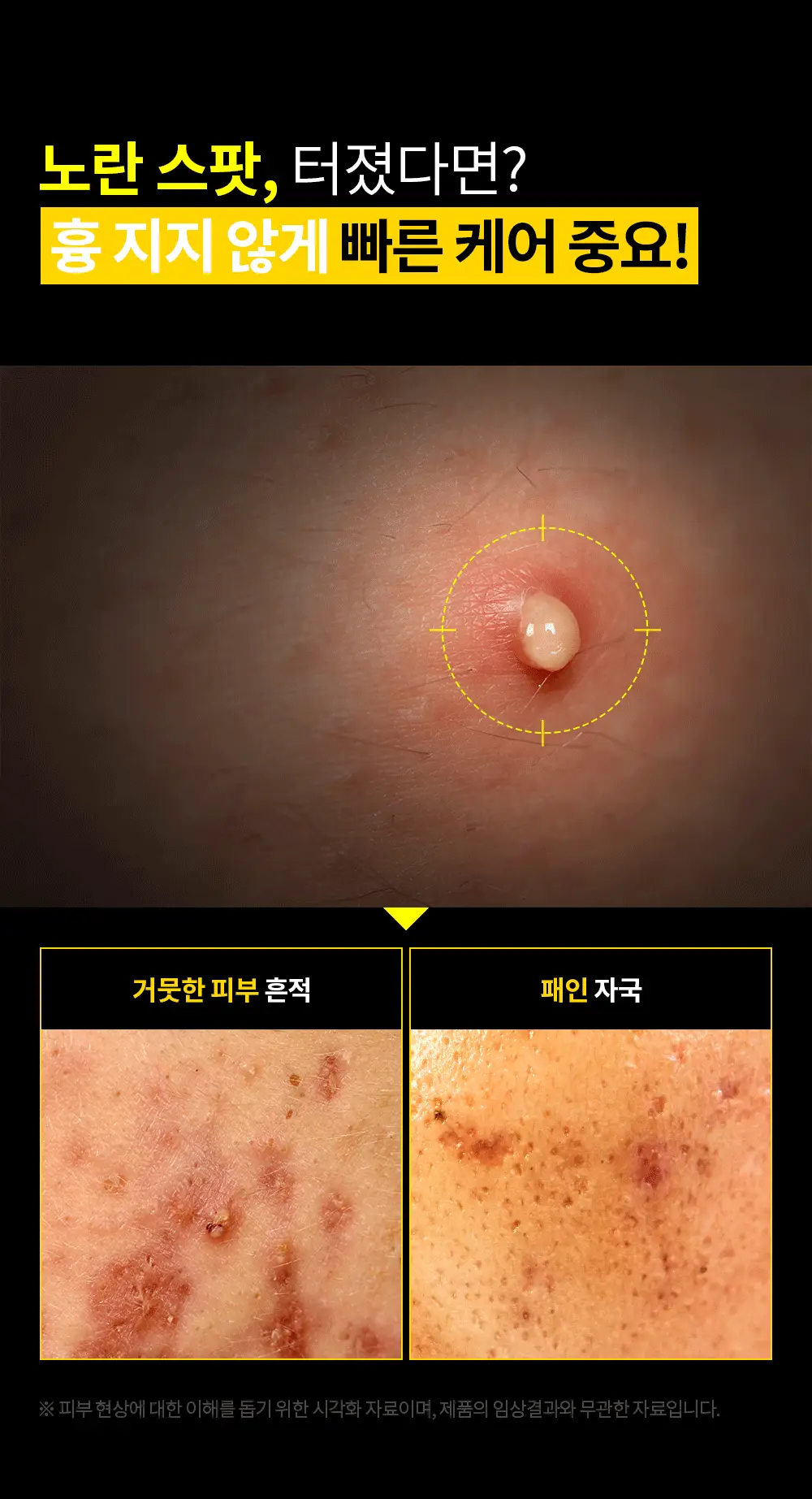트러블레스 인비저블 플러스 스팟패치 더 클래식 96패치 상세페이지 5