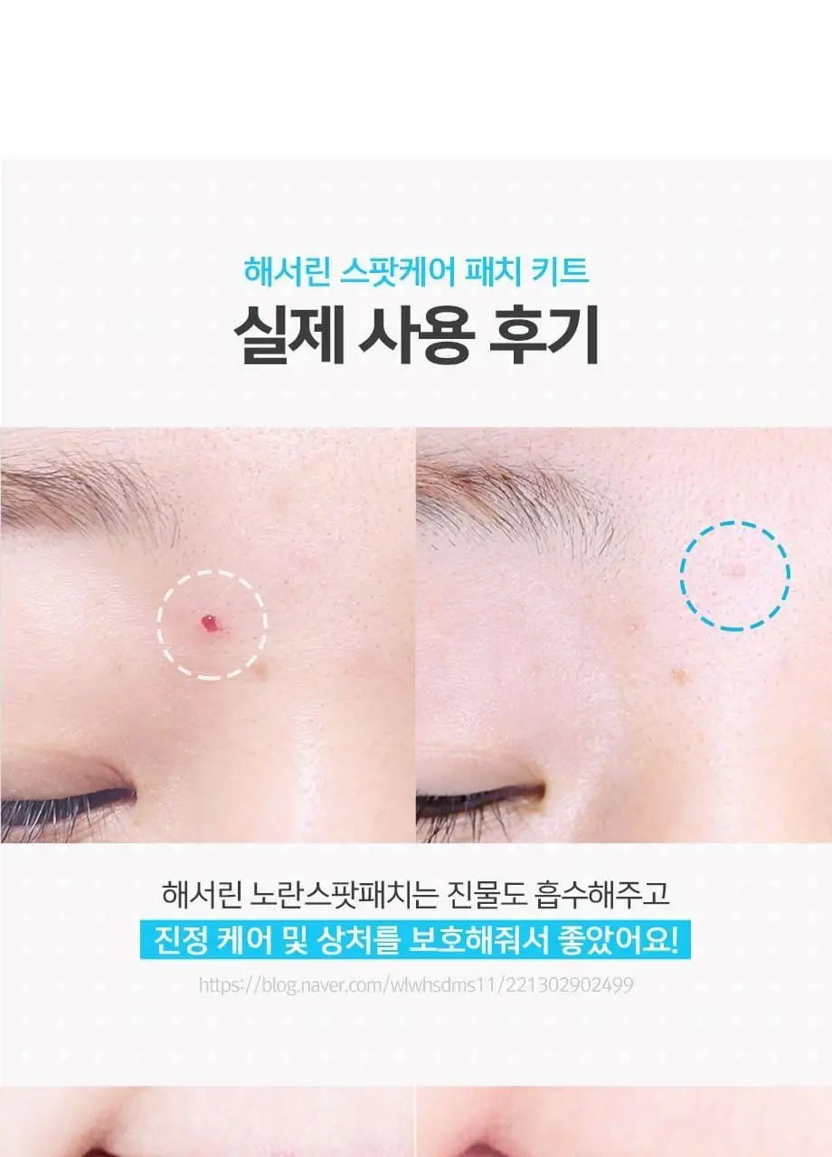 해서린 스팟케어 패치 4종 (패치140매/붉은스팟/노란스팟/젤) 상세페이지 14