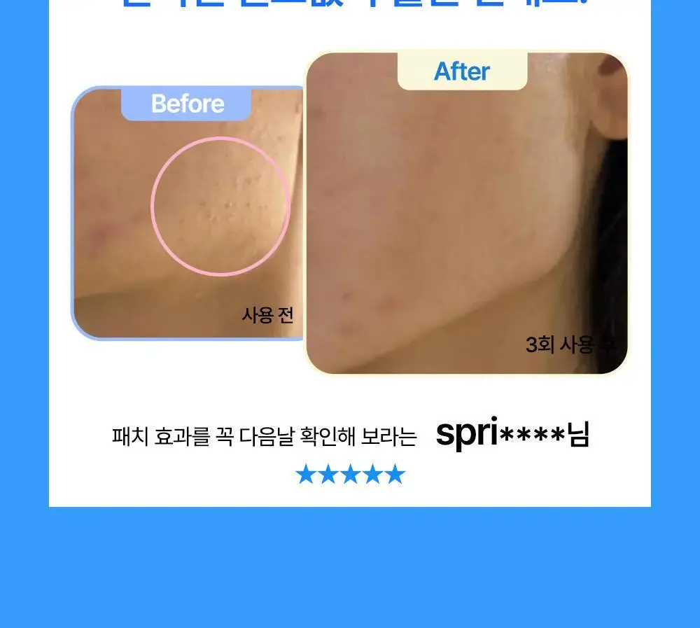 닥터웰메이드원 좁쌀피지 순삭패치 마일드 30매 상세페이지 5