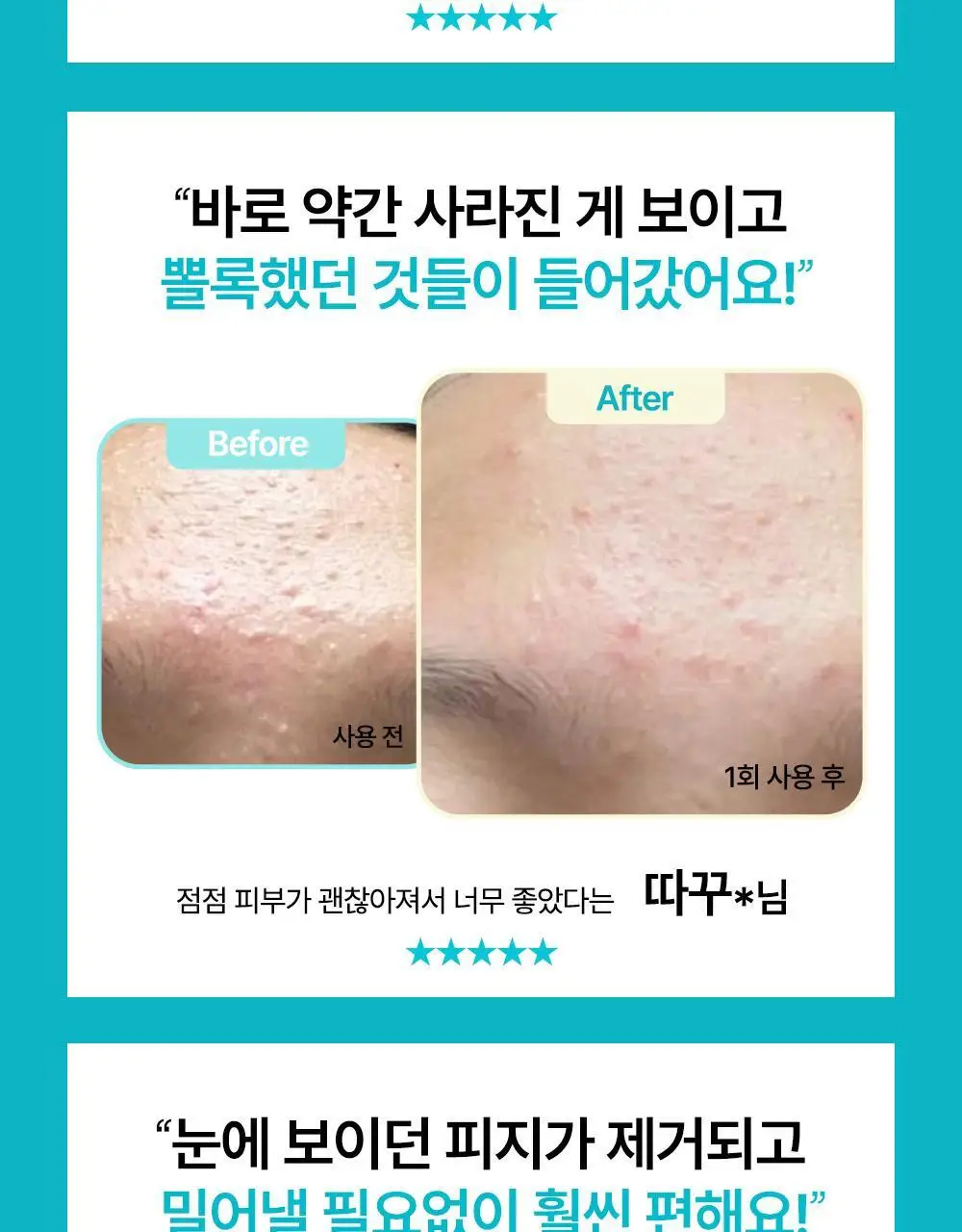 닥터웰메이드원 좁쌀피지 순삭패치 슈퍼마일드 30매 상세페이지 5