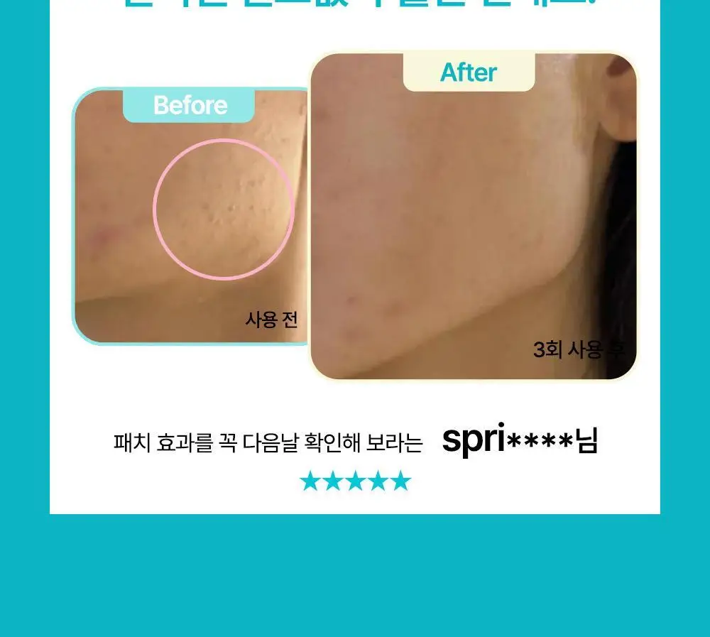 닥터웰메이드원 좁쌀피지 순삭패치 슈퍼마일드 30매 상세페이지 6