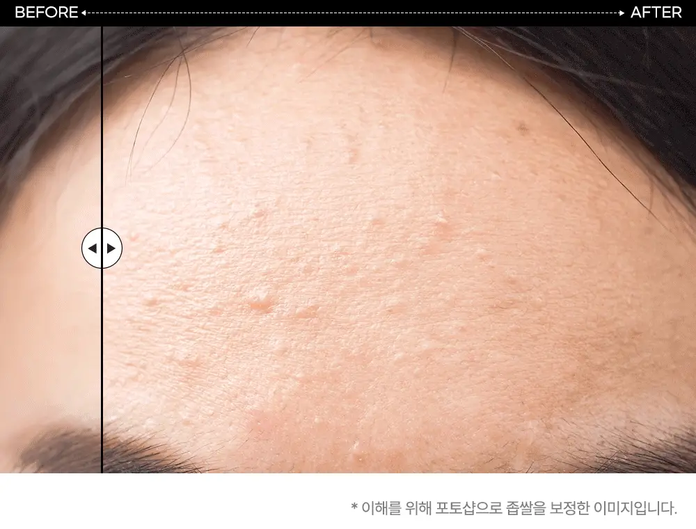 닥터웰메이드원 좁쌀피지 순삭패치 증량 기획 30+10매 2종 택1(마일드/슈퍼마일드) 상세페이지 37
