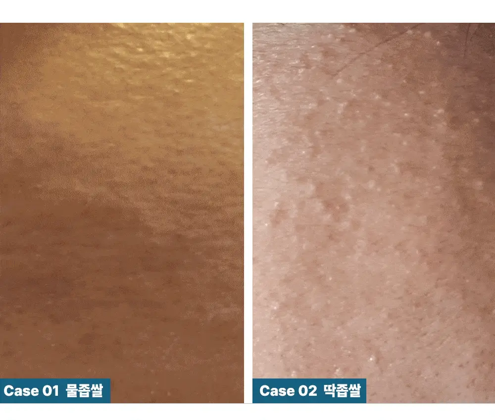 닥터웰메이드원 좁쌀피지 순삭패치 증량 기획 30+10매 2종 택1(마일드/슈퍼마일드) 상세페이지 56
