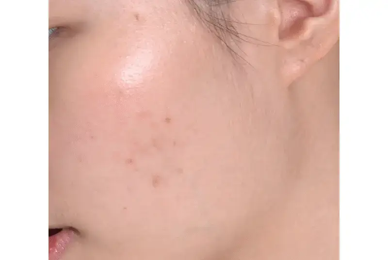 메디필 에이씨 티 클리어 50ml 상세페이지 7