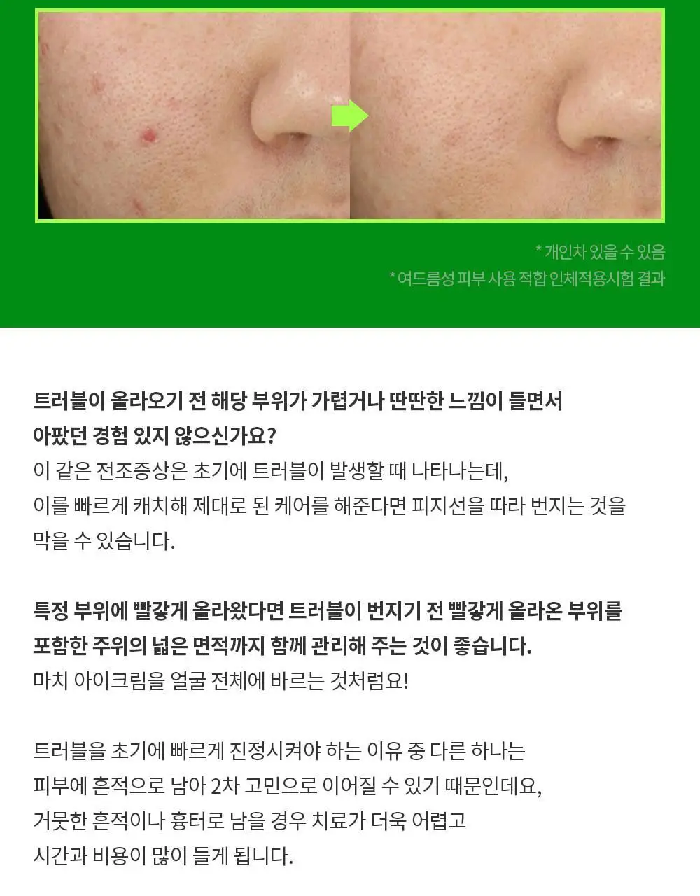 트러블레스 클리어 젤 크림 (스팟) 15ml 상세페이지 4